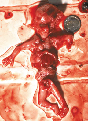 One of the millions of babies aborted every year in America